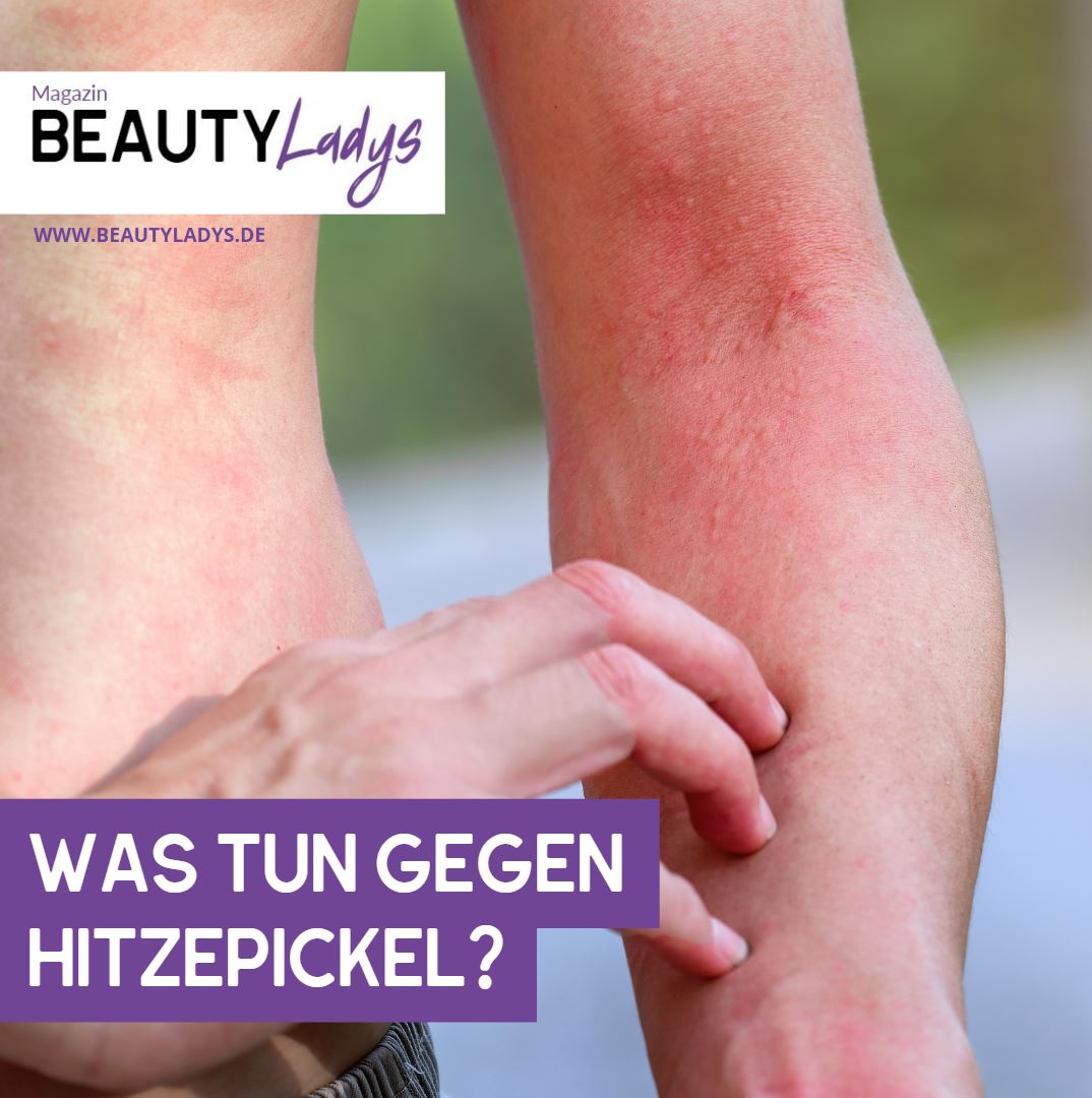 Was tun gegen Hitzepickel – Behandlungsmöglichkeiten Was tun gegen Hitzepickel – Behandlungsmöglichkeiten