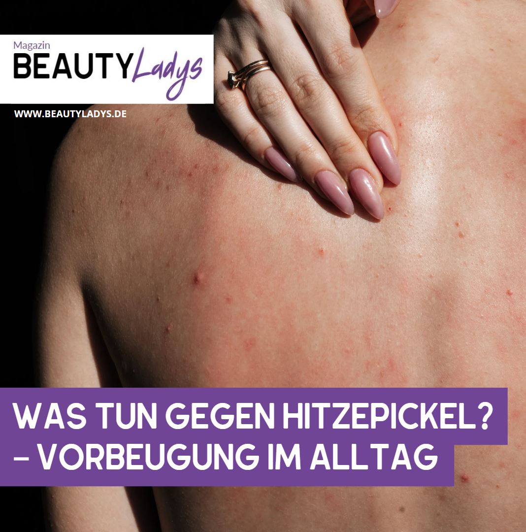 Was tun gegen Hitzepickel – Vorbeugung im Alltag Was tun gegen Hitzepickel – Vorbeugung im Alltag