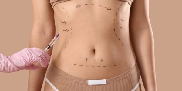 Liposuktion bei Lipödem Die operative Behandlung und Stadien